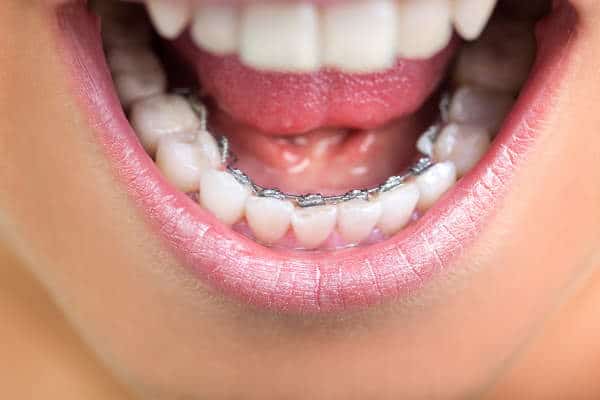 Lingual Braces in Westminster