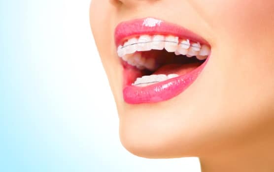 Clear Braces in Arvada community