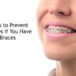 5 Easy Tips to Prevent Cavities if You Have Braces